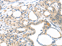 Immunohistochemistry of paraffin-embedded Human thyroid cancer tissue using MASP2 Polyclonal Antibody at dilution 1:35