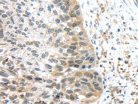 Immunohistochemistry of paraffin-embedded Human esophagus cancer tissue using TSPY1/3 Polyclonal Antibody at dilution 1:45