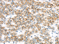 Immunohistochemistry of paraffin-embedded Human liver cancer tissue using TTBK2 Polyclonal Antibody at dilution 1:40