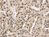 Immunohistochemistry of paraffin-embedded Human liver cancer using TUSC5 Polyclonal Antibody at dilution of 1/40