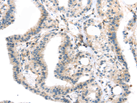 Immunohistochemistry of paraffin-embedded Human thyroid cancer using TBXA2R Polyclonal Antibody at dilution of 1/40