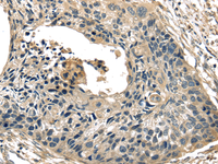 Immunohistochemistry of paraffin-embedded Human esophagus cancer tissue using TXNIP Polyclonal Antibody at dilution 1:40