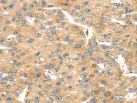 Immunohistochemistry of paraffin-embedded Human liver cancer tissue using UBTD2 Polyclonal Antibody at dilution 1:40