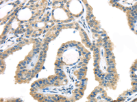 Immunohistochemistry of paraffin-embedded Human thyroid cancer using VGF Polyclonal Antibody at dilution of 1/45