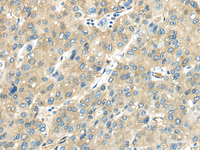 Immunohistochemistry of paraffin-embedded Human liver cancer tissue using VPS4A Polyclonal Antibody at dilution 1:40