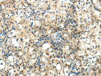 Immunohistochemistry of paraffin-embedded Human prostate cancer using WNT2 Polyclonal Antibody at dilution of 1/40