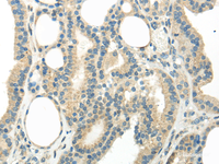 Immunohistochemistry of paraffin-embedded Human thyroid cancer tissue using WNT6 Polyclonal Antibody at dilution 1:35