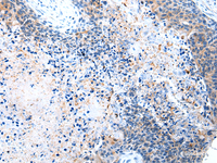 Immunohistochemistry of paraffin-embedded Human esophagus cancer tissue using COLEC12 Polyclonal Antibody at dilution 1:40