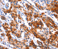 Immunohistochemistry of paraffin-embedded Human lung cancer tissue using SEPT4 Polyclonal Antibody at dilution 1:50