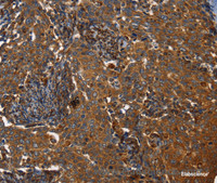 Immunohistochemistry of paraffin-embedded Human liver cancer using TPM2 Polyclonal Antibody at dilution of 1:35