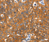 Immunohistochemistry of paraffin-embedded Human ovarian cancer tissue using SLC2A2 Polyclonal Antibody at dilution 1:30