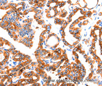 Immunohistochemistry of paraffin-embedded Human thyroid cancer tissue using SEPT4 Polyclonal Antibody at dilution 1:50