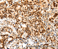 Immunohistochemistry of paraffin-embedded Human gastic cancer using Proliferating Cell Nuclear Antigen Polyclonal Antibody at dilution of 1:44