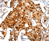 Immunohistochemistry of paraffin-embedded Human breast cancer using Proliferating Cell Nuclear Antigen Polyclonal Antibody at dilution of 1:44