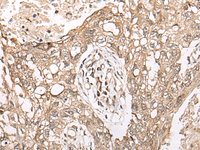 Immunohistochemistry of paraffin-embedded Human lung cancer tissue using M1AP Polyclonal Antibody at dilution of 1:45 (×200)