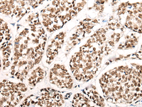 Immunohistochemistry of paraffin-embedded Human esophagus cancer tissue using HGH1 Polyclonal Antibody at dilution of 1:45 (×200)