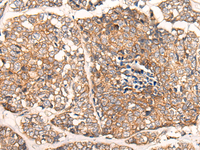 Immunohistochemistry of paraffin-embedded Human esophagus cancer tissue using CACNA2D2 Polyclonal Antibody at dilution of 1:45 (×200)