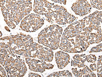 Immunohistochemistry of paraffin-embedded Human esophagus cancer tissue using CALB1 Polyclonal Antibody at dilution of 1:80 (×200)