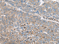 Immunohistochemistry of paraffin-embedded Human liver cancer tissue using GULP1 Polyclonal Antibody at dilution of 1:65 (×200)