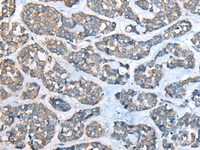 Immunohistochemistry of paraffin-embedded Human esophagus cancer tissue using GULP1 Polyclonal Antibody at dilution of 1:65 (×200)