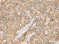 Immunohistochemistry of paraffin-embedded Human liver cancer tissue using CHKA Polyclonal Antibody at dilution of 1:35 (×200)