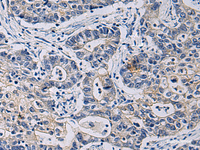 Immunohistochemistry of paraffin-embedded Human gastric cancer tissue using CHST3 Polyclonal Antibody at dilution of 1:35 (×200)