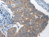 Immunohistochemistry of paraffin-embedded Human colorectal cancer tissue using RTN4IP1 Polyclonal Antibody at dilution of 1:50 (×200)