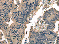 Immunohistochemistry of paraffin-embedded Human colorectal cancer tissue using DNAJC2 Polyclonal Antibody at dilution of 1:40 (×200)