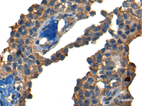 Immunohistochemistry of paraffin-embedded Human ovarian cancer tissue using DNAJC2 Polyclonal Antibody at dilution of 1:40 (×200)