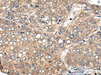 Immunohistochemistry of paraffin-embedded Human liver cancer tissue using ACER1 Polyclonal Antibody at dilution of 1:50 (×200)