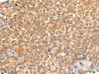 Immunohistochemistry of paraffin-embedded Human ovarian cancer tissue using UBIAD1 Polyclonal Antibody at dilution of 1:40 (×200)