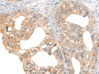 Immunohistochemistry of paraffin-embedded Human gastric cancer tissue using CORO2A Polyclonal Antibody at dilution of 1:45 (×200)