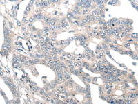 Immunohistochemistry of paraffin-embedded Human liver cancer tissue using NOG Polyclonal Antibody at dilution of 1:50 (×200)