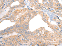 Immunohistochemistry of paraffin-embedded Human thyroid cancer tissue using RGS19 Polyclonal Antibody at dilution of 1:40 (×200)