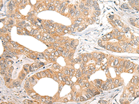 Immunohistochemistry of paraffin-embedded Human gastric cancer tissue using SNX6 Polyclonal Antibody at dilution of 1:40 (×200)