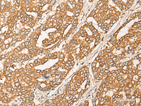 Immunohistochemistry of paraffin-embedded Human liver cancer tissue using GNB1L Polyclonal Antibody at dilution of 1:35 (×200)