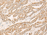 Immunohistochemistry of paraffin-embedded Human liver cancer tissue using COX6C Polyclonal Antibody at dilution of 1:25 (×200)