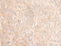 Immunohistochemistry of paraffin-embedded Human esophagus cancer tissue using COX6C Polyclonal Antibody at dilution of 1:25 (×200)