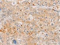 Immunohistochemistry of paraffin-embedded Human prost ate cancer tissue using FBXO32 Polyclonal Antibody at dilution of 1:45 (×200)