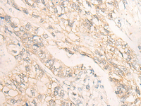 Immunohistochemistry of paraffin-embedded Human gastric cancer tissue using DMTN Polyclonal Antibody at dilution of 1:35 (×200)