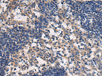 Immunohistochemistry of paraffin-embedded Human esophagus cancer tissue using DMRTA2 Polyclonal Antibody at dilution of 1:50 (×200)