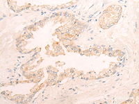 Immunohistochemistry of paraffin-embedded Human prost ate cancer tissue using ELANE Polyclonal Antibody at dilution of 1:25 (×200)