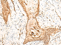 Immunohistochemistry of paraffin-embedded Human esophagus cancer tissue using EMSY Polyclonal Antibody at dilution of 1:25 (×200)