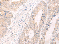 Immunohistochemistry of paraffin-embedded Human colorectal cancer tissue using IL33 Polyclonal Antibody at dilution of 1:25 (×200)