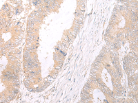 Immunohistochemistry of paraffin-embedded Human colorectal cancer tissue using HLA-C Polyclonal Antibody at dilution of 1:25 (×200)