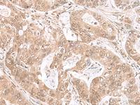 Immunohistochemistry of paraffin-embedded Human gastric cancer tissue using ETV3 Polyclonal Antibody at dilution of 1:25 (×200)