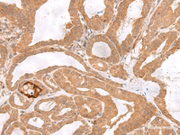 Immunohistochemistry of paraffin-embedded Human thyroid cancer tissue using ETV3 Polyclonal Antibody at dilution of 1:25 (×200)