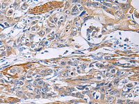 Immunohistochemistry of paraffin-embedded Human esophagus cancer tissue using FBXO45 Polyclonal Antibody at dilution of 1:40 (×200)