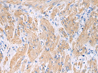 Immunohistochemistry of paraffin-embedded Human gastric cancer tissue using FBXO45 Polyclonal Antibody at dilution of 1:40 (×200)