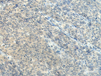 Immunohistochemistry of paraffin-embedded Human ovarian cancer tissue using CTDP1 Polyclonal Antibody at dilution of 1:55 (×200)